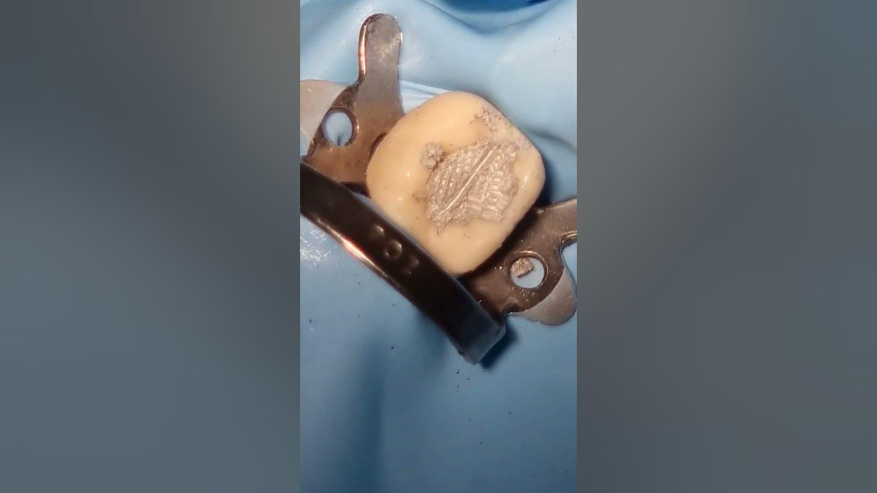Amalgam Filling Procedure Step by Step YouTube