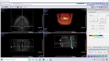 PreXion Training Tips: Airway Analysis