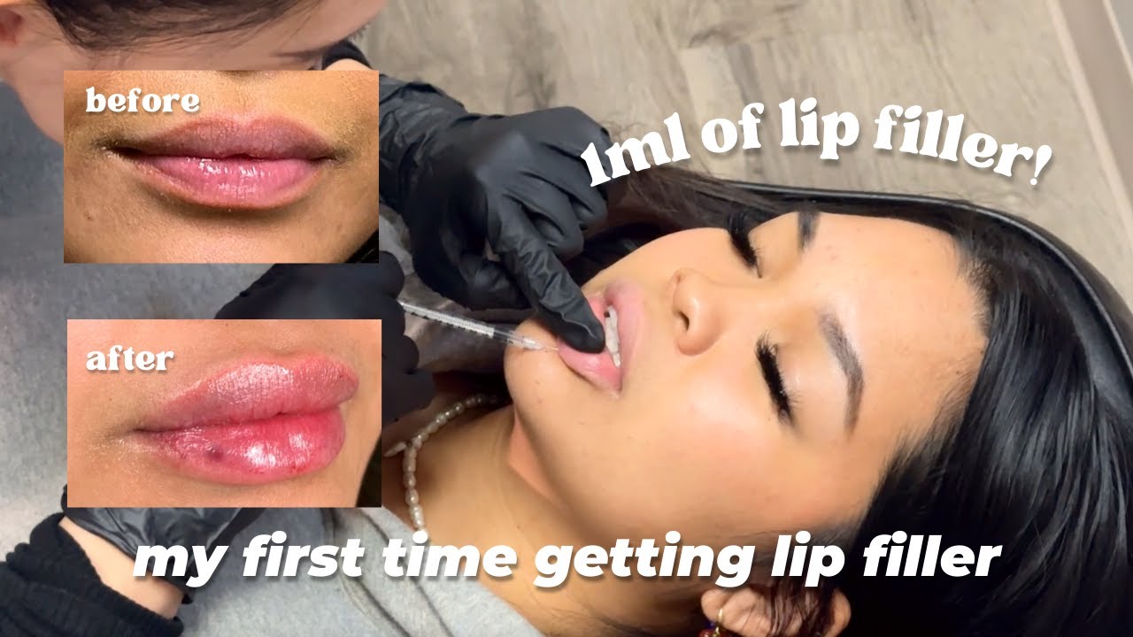 my first getting lip filler ~ vlog & my experience