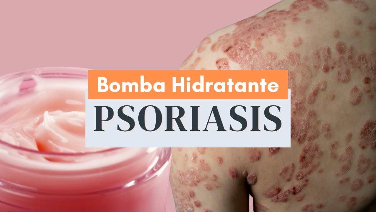 PSORIASIS: BOMBA SUPER HIDRATANTE para mejorar la piel!