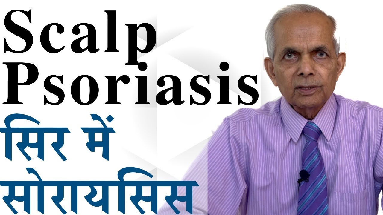 Scalp Psoriasis- सिर में सोरायसिस का इलाज