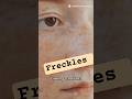 Freckles cute hain, lekin sun damage serious hai ☀️ #skincare #sunscreen #freckles