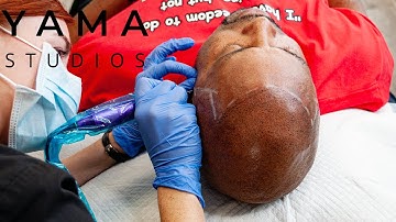 How Long Does Scalp Micropigmentation Take to Heal? SMP Explained