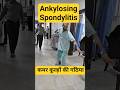 Ankylosing spondylitis #shorts #trending #viral #ankylosingspondylitis #ankylosing_spondylitis
