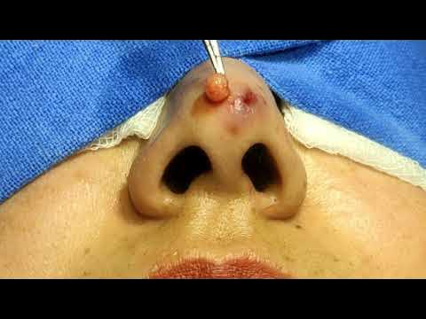 Nasal Tip Retention Cyst - YouTube