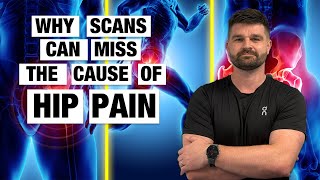 3 Most Common Causes Of Hip Pain (Arthritis, Labral Tear and Impingement)
