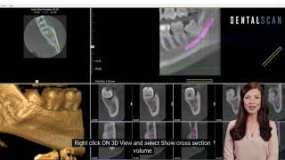 3rd Molar 3d Manipulation Tutorial On Icat Vision