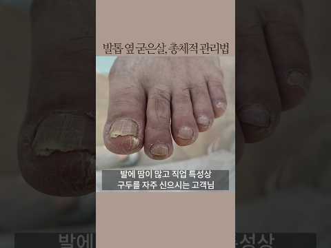 관리하면 좋아질 수 있나요?!🤔 직접 확인해 보세요😉👍#발톱무좀#발각질#refusshj#레푸스화정#화정역발#레푸스#shorts