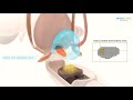 Sonablate hifu prostate cancer treatment animation part i  ii