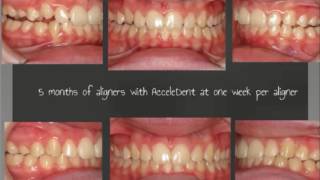 AcceleDent Aligner Series Featuring Dr. Sonia Palleck