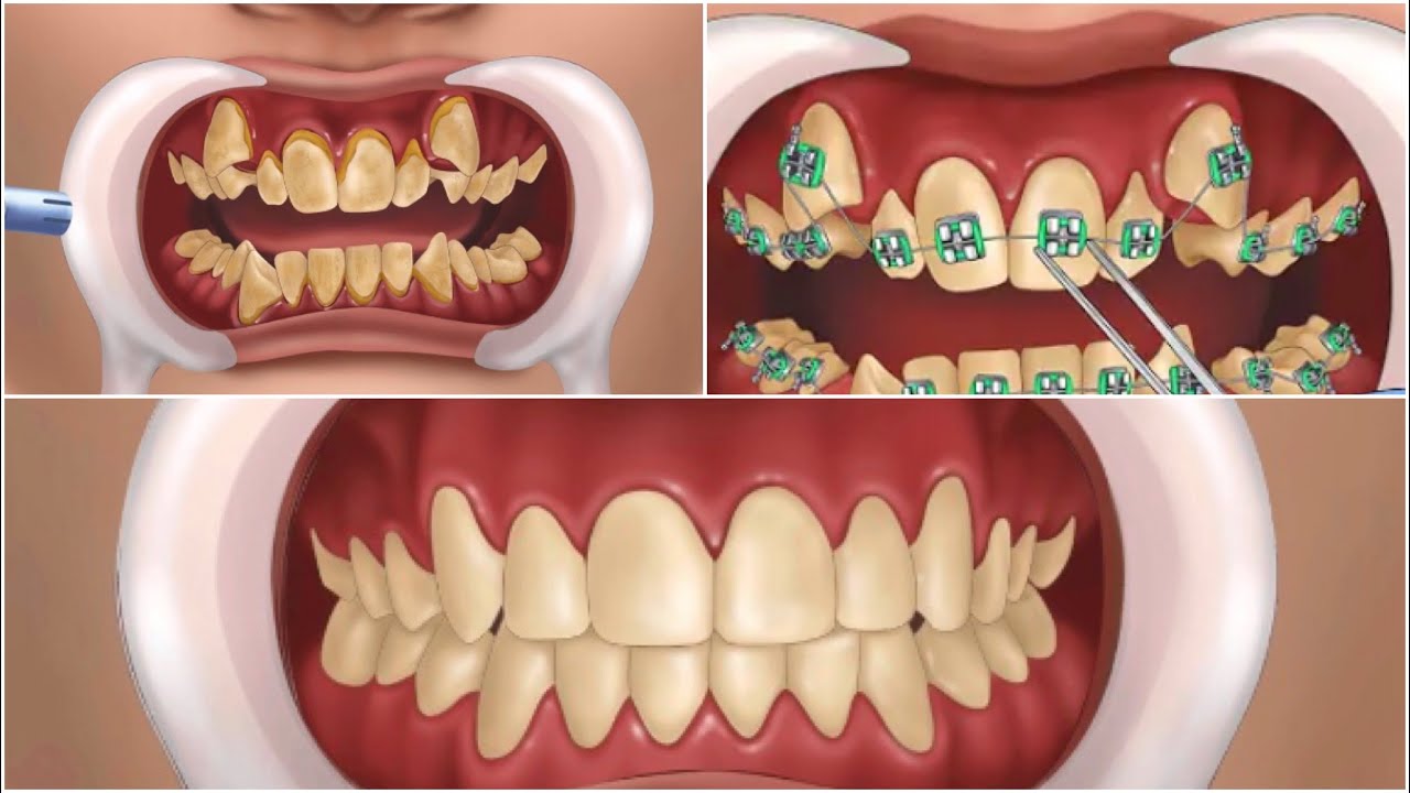 ASMR Braces Animation 🦷 Satisfying Video😇 Dental Care YouTube
