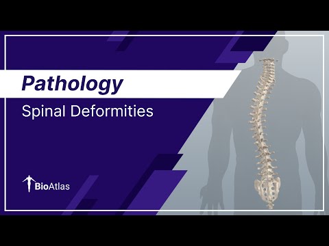 Spinal Deformities |