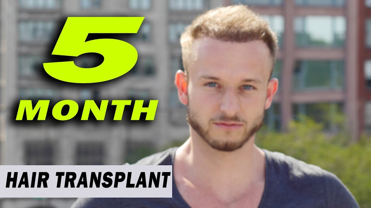 Hair Transplant Recovery Timeline  0  14 Months Photos