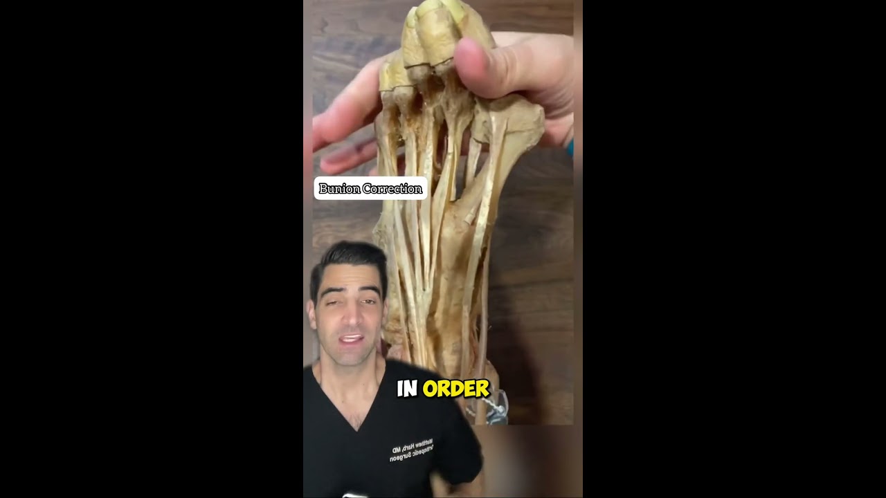 Bunion Correction