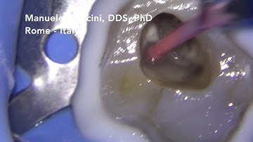 Dr. Manuele Mancini - Manual Dynamic Irrigation - Endodonzia - MDA - Endodontics - Rome - Italy