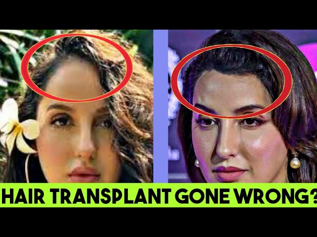 Celebrity Hair Transplant  Top 6 Bollywood Actors who went for Hair  Transplant  DHI India