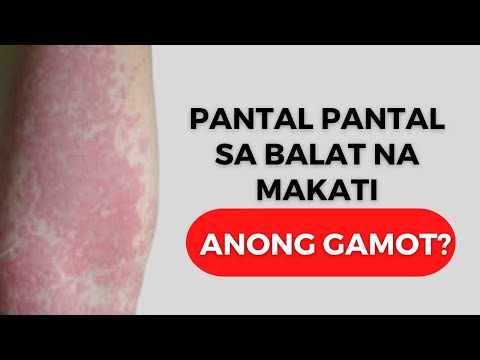 Video: Paano Gamutin Ang Pantal Sa Sanggol Na Pantal