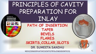 Principles of Inlay cavity preparation| inlay cavity preparation| bevels in inlay