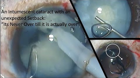 An intumescent cataract with Semi-Section technique of IOL explantation - an unexpected setback