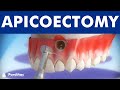 Apicoectomy  treatment of root canal infection 