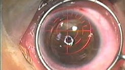 LASIK under General Anesthesia, 2001 - Jonathan M. Davidorf, MD