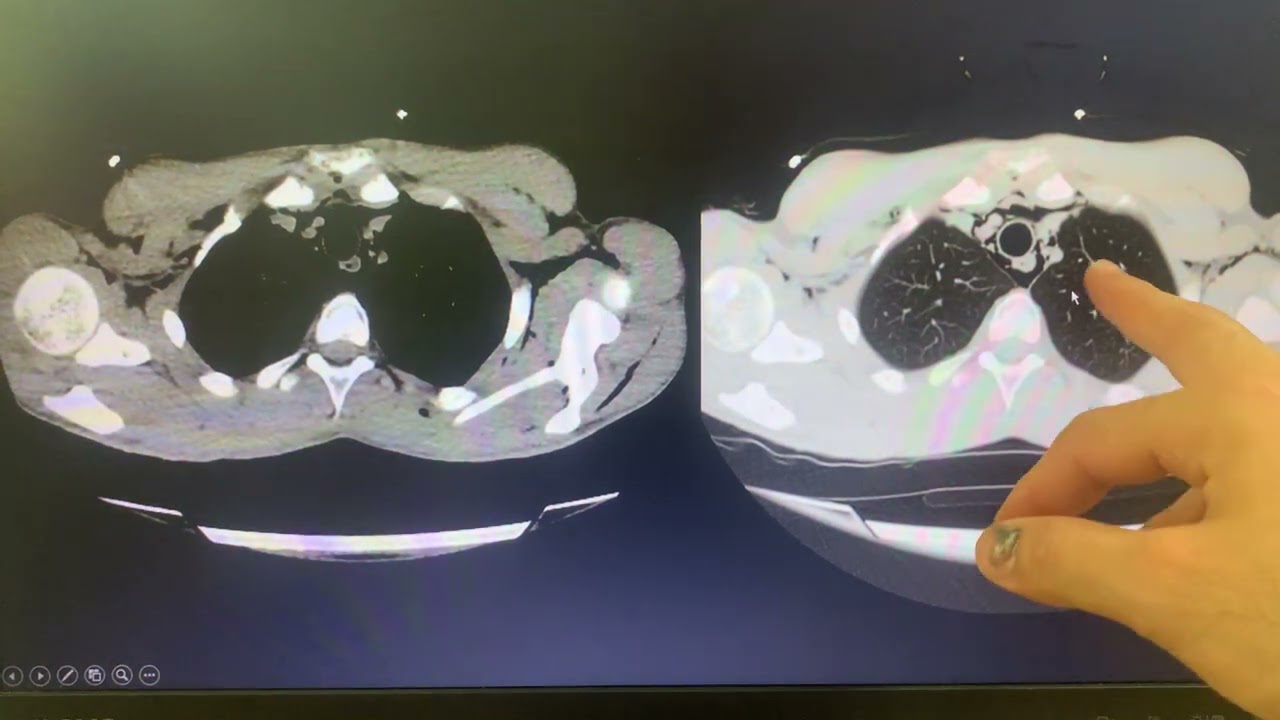 Dr Hilmi Keskin '' Toraks Tomografisi anlatımı 4. Bölüm ''