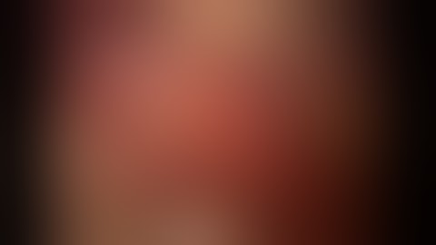 Laparoscopic retroperitoneal pyelolithotomy