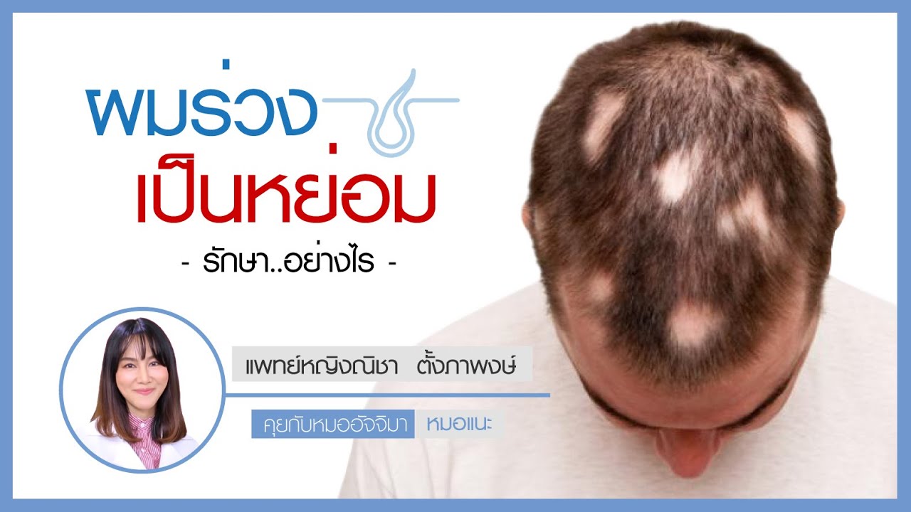 ผมร่วงเป็นหย่อม รักษาอย่างไร ผมร่วงเป็นหย่อม รักษาอย่างไร