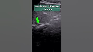 Acid Reflux - GERD | Ultrasound Diagnosis    #ultrasound #gerd #acidity #acidreflux
