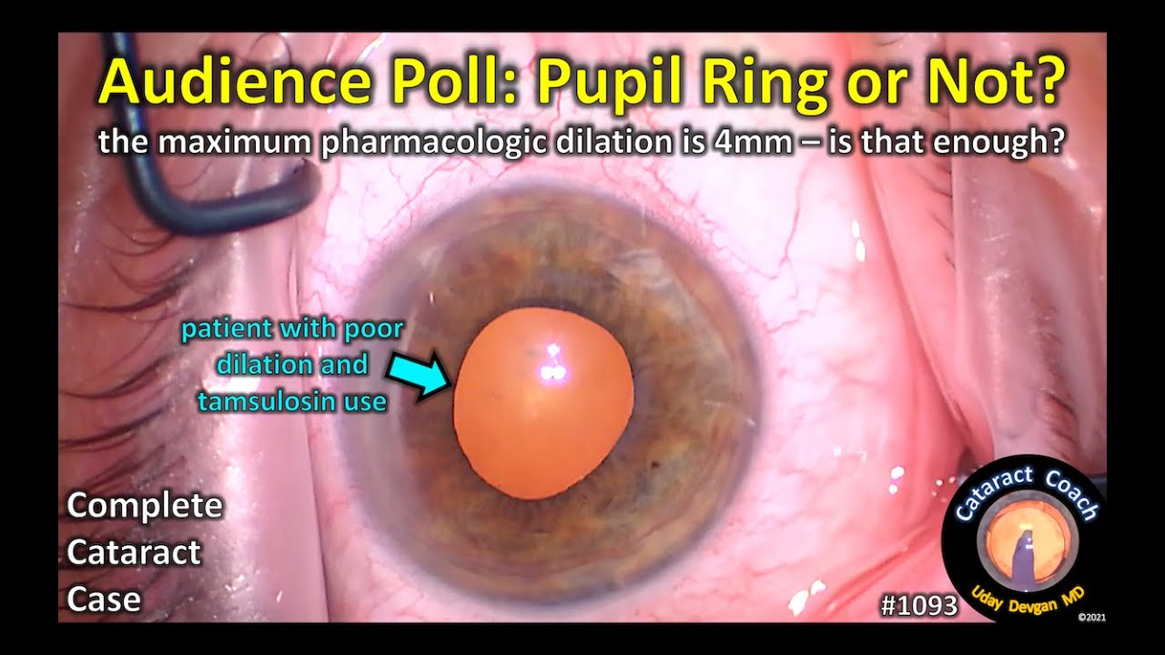 PDF) Correction: Management and outcomes of the small pupil in cataract  surgery: iris hooks, Malyugin ring or phenylephrine?