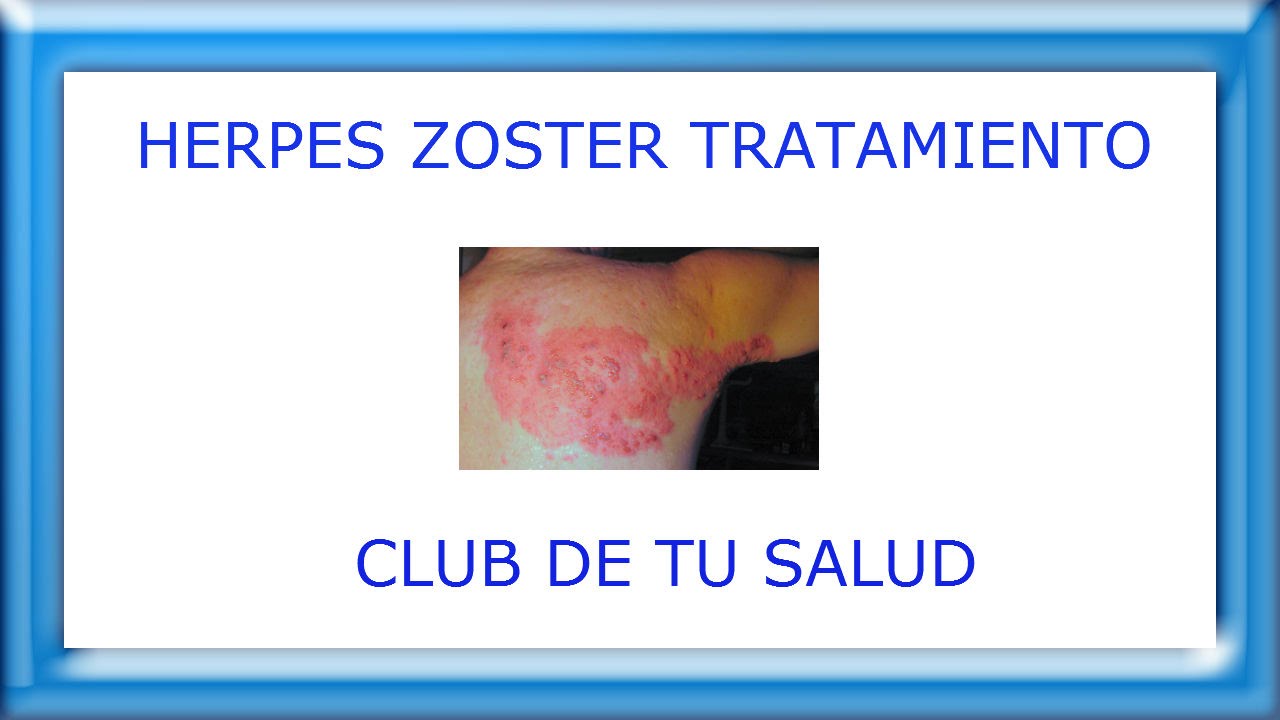 Herpes zoster tratamiento. Tratamiento casero natural para el herpes