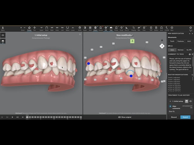 Align Technology unveils new version of its ClinCheck treatment