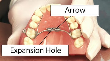 Orthodontics Limited Turning Expander Video