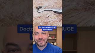 Doctor reacts to MASSIVE dilated pore extraction! #dermreacts #doctorreacts #dialatedpore