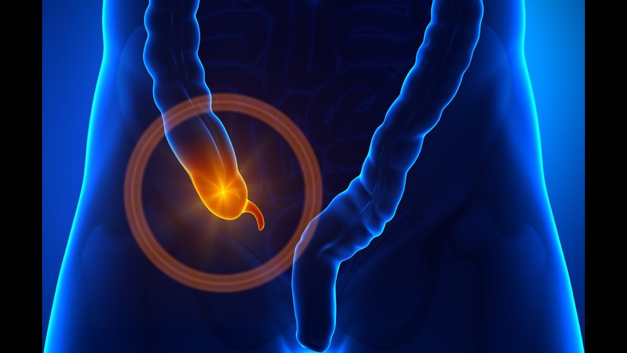 Аппендицит в организме. Возбудители аппендицита. Острый аппендицит фото.
