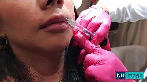 Lip Filler Treatment | Slate Medspa | Sandy