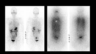 Thyroid Scan Teaching File from Nuclear Medicine Handbook