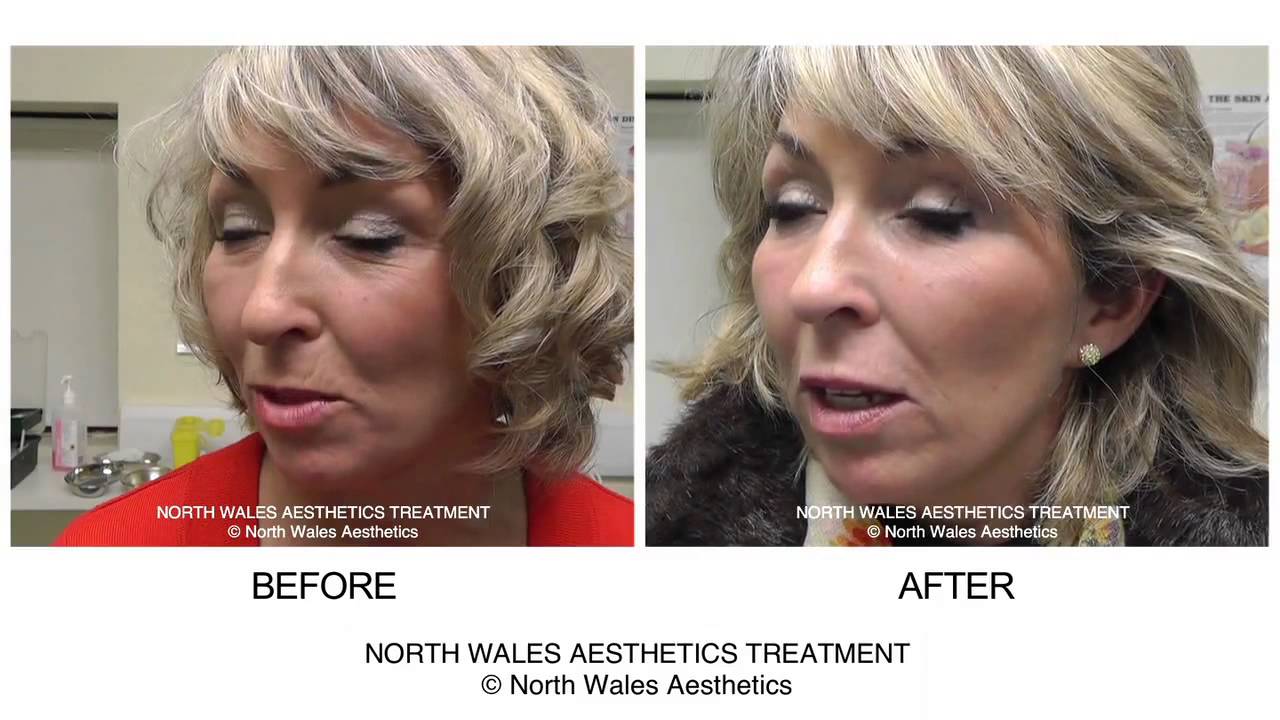 Nia Full Face Side Talking Dermal filler treatment Before & After Video