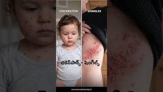 Chickenpox Vaccine vs Natural Infection | Which is Better for Your Child?