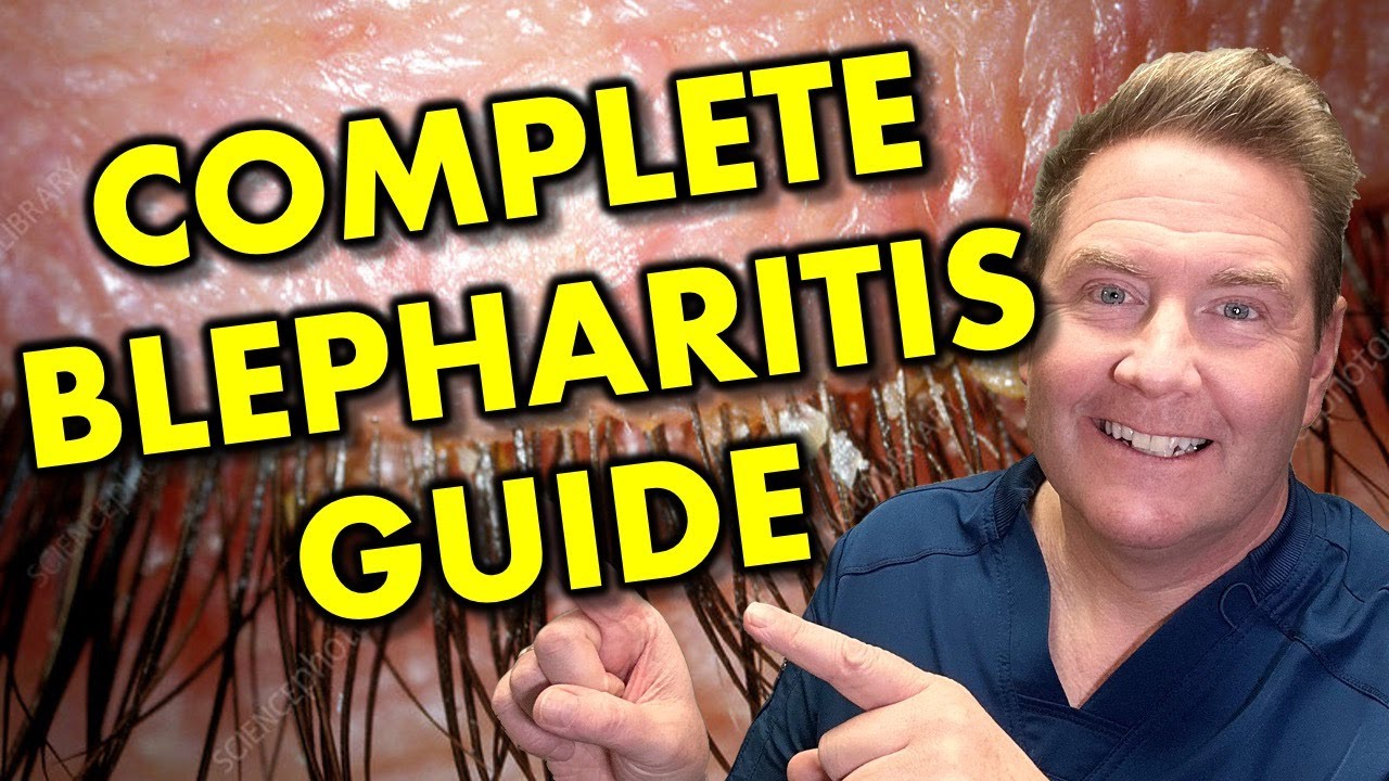 Все о типах, симптомах и лечении блефарита