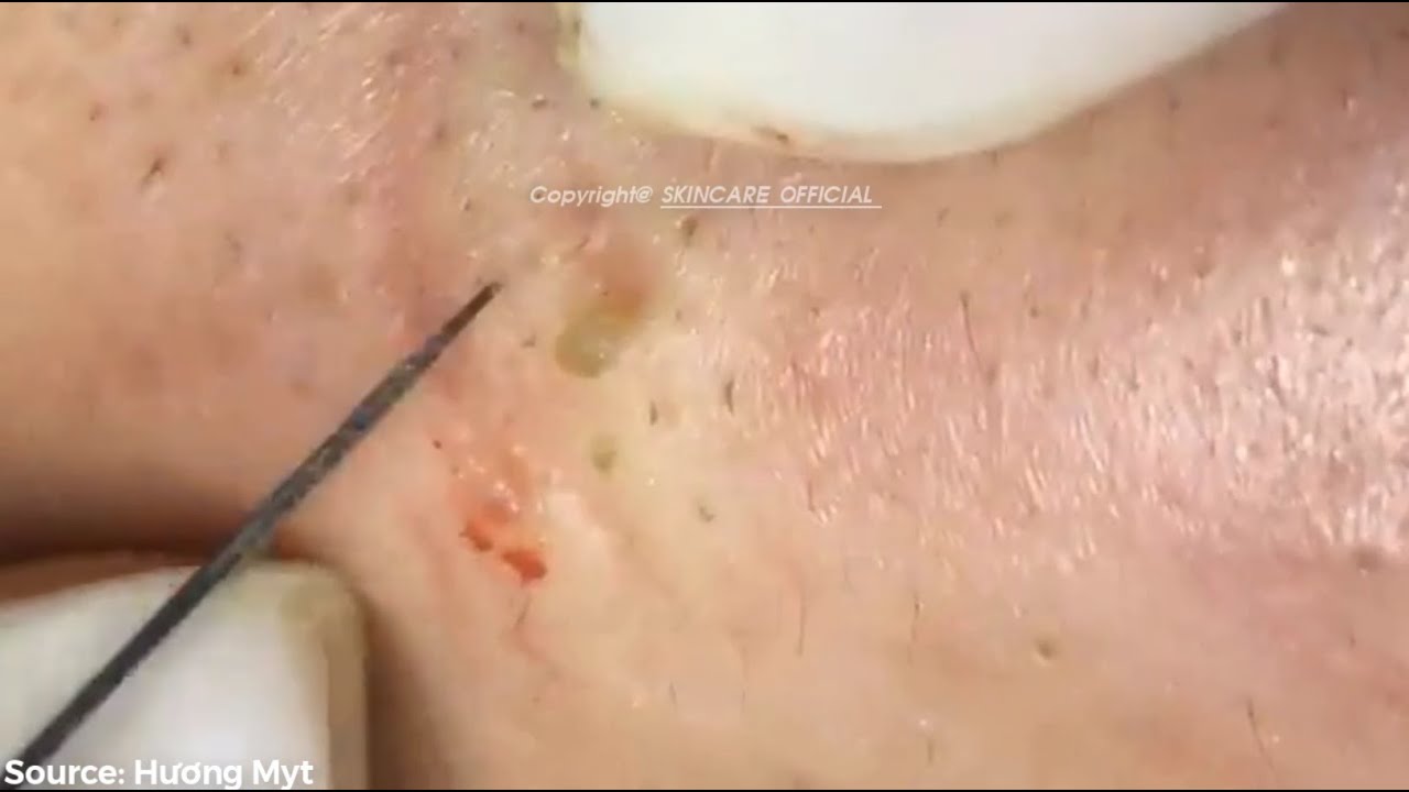 Worst Case Removal Blackheads On The Face Easy How To Remove Blackheads Easy SS01E17 YouTube