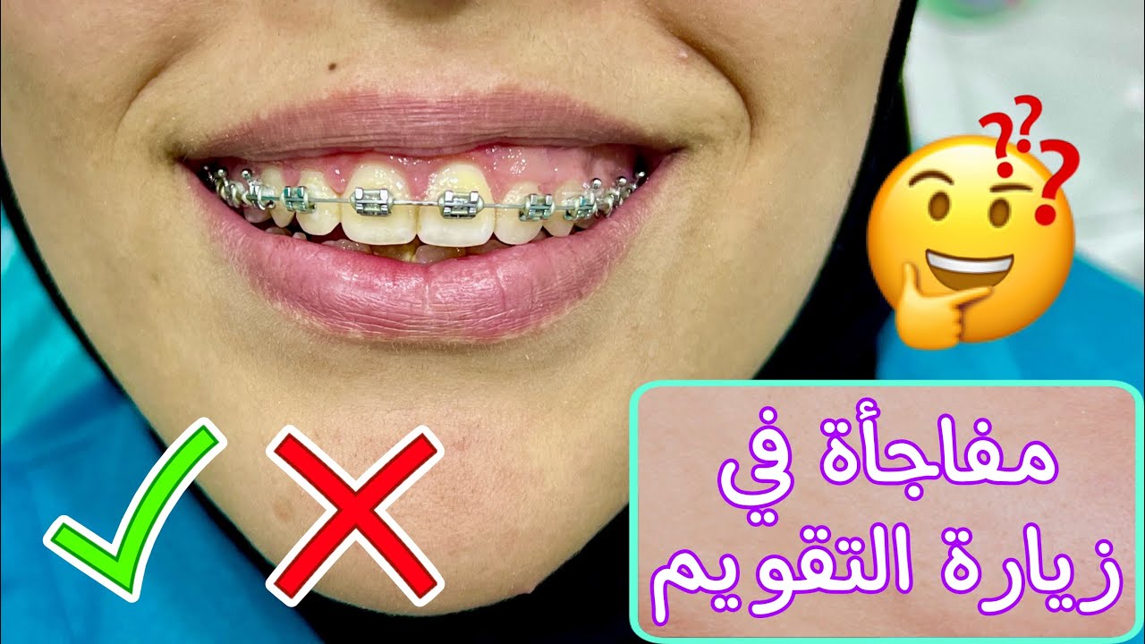 طريقة شد التقويم | ألوان التقويم | تنظيف جير الأسنان مع جلسه التقويم