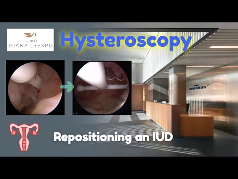Repositioning IUD