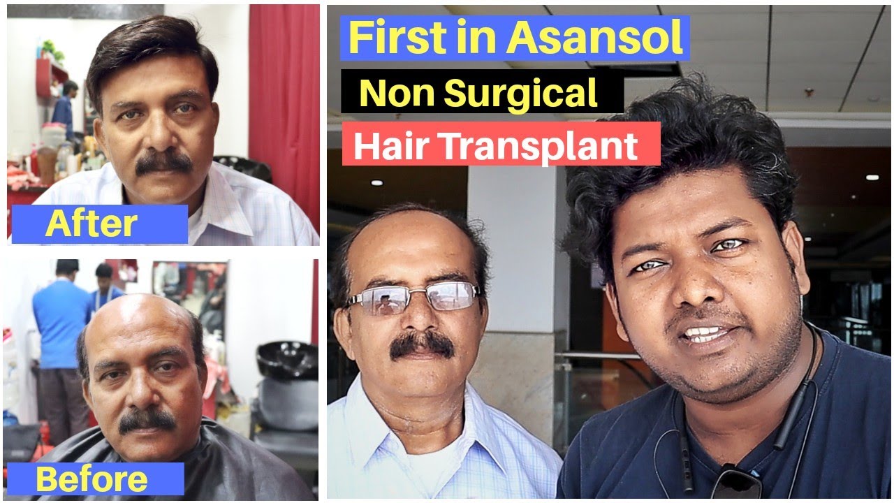 Non Surgical Hair Transplant First in Asansol Sentrum 4 Men & Women