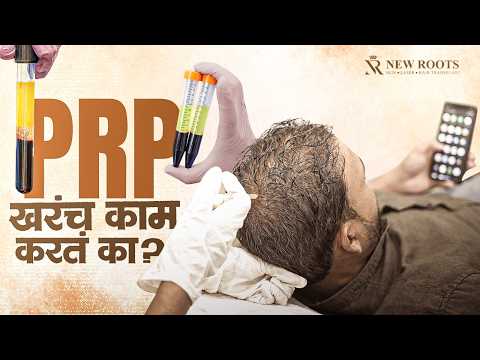 Is PRP Effective for HAIR GROWTH After Transplant? 🤔 | New Roots | Marathi