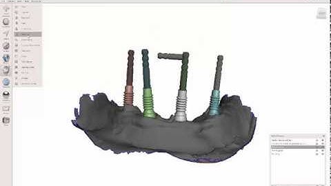 Multiunit Abutment Plug