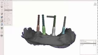 Multiunit Abutment Plug