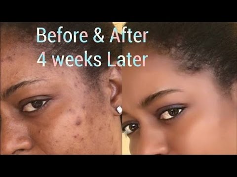 How long does it take for dark spots on the face to fade away?