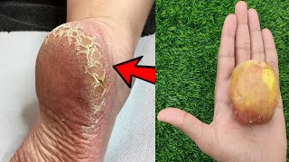 Eliminate Cracked Heels And Get White And Smooth Feet \/ Magic Cracked Heels Home Remedy