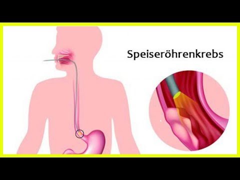 Video: Polyp Der Speiseröhre: Symptome, Behandlung, Ursachen, Diagnose